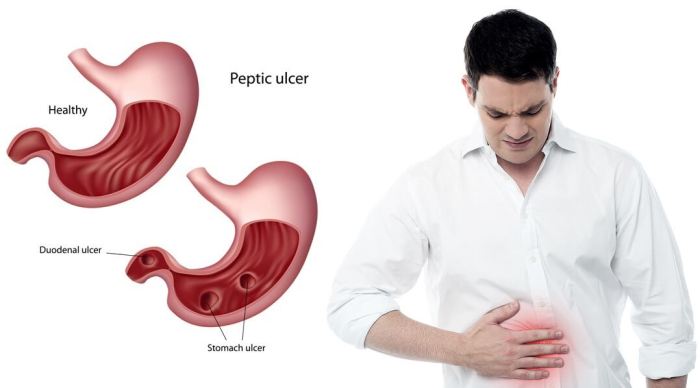 Peptic ulcer disease hesi case study